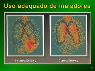 8787
Uso adequado de inaladoresUso adequado de inaladores
 