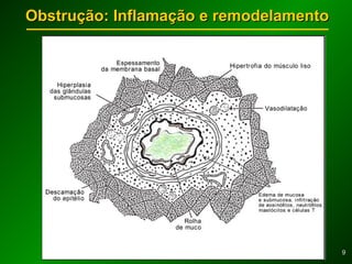 99
Obstrução: Inflamação e remodelamentoObstrução: Inflamação e remodelamento
 