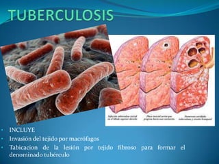 • INCLUYE
• Invasión del tejido por macrófagos
• Tabicacion de la lesión por tejido fibroso para formar el
denominado tubérculo
 