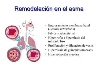 • Engrosamiento membrana basal
(Lamina reticularis)
• Fibrosis subepitelial
• Hipertrofia e hiperplasia del
músculo liso
• Proliferación y dilatación de vasos
• Hiperplasia de glándulas mucosas
• Hipersecreción mucosa
Remodelación en el asmaRemodelación en el asma
 