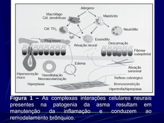 Figura 1 – As complexas interações celulares neurais
presentes na patogenia da asma resultam em
manutenção da inflamação e conduzem ao
remodelamento brônquico.
 