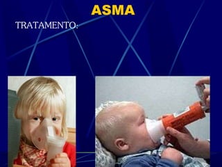 ASMA
TRATAMENTO:
 