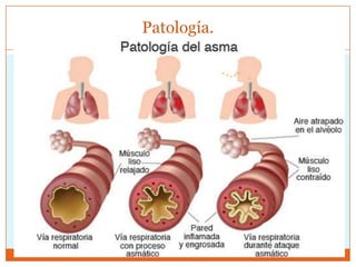 Patología.
 Histológicamente aumento de células caliciformes 

sustituyen a las ciliadas.
 Engrosamiento de membrana basal y eosinofilia
 Aumento de células cebadas.
 Hipertrofia del musculo liso bronquial.

 