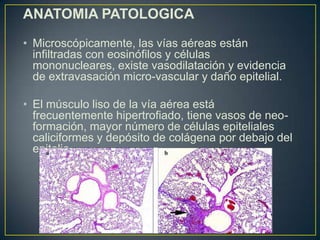 ANATOMIA PATOLOGICA
• Microscópicamente, las vías aéreas están
infiltradas con eosinófilos y células
mononucleares, existe vasodilatación y evidencia
de extravasación micro-vascular y daño epitelial.
• El músculo liso de la vía aérea está
frecuentemente hipertrofiado, tiene vasos de neoformación, mayor número de células epiteliales
caliciformes y depósito de colágena por debajo del
epitelio.

 