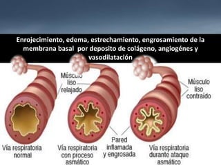 INFLAMACIÓNINFLAMACIÓN crónica de la mucosa de
las vías bajas, desde tráquea hasta
bronquiolos terminales predominando
en bronquios.
Se acompaña de HIPERREACTIVIDAD
de las vías respiratorias.
HIPERREACTIVIDAD
Enrojecimiento, edema, estrechamiento, engrosamiento de la
membrana basal por deposito de colágeno, angiogénes y
vasodilatación
 
