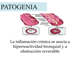 PATOGENIA
La inflamación crónica se asocia a
hiperreactividad bronquial y a
obstrucción reversible
 