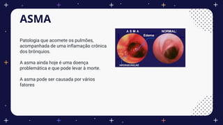 ASMA
Patologia que acomete os pulmões,
acompanhada de uma inflamação crônica
dos brônquios.
A asma ainda hoje é uma doença
problemática e que pode levar à morte.
A asma pode ser causada por vários
fatores
 
