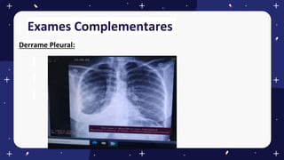 Exames Complementares
Derrame Pleural:
 