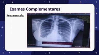 Exames Complementares
Pneumatocele:
 