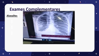 Exames Complementares
Alveolite:
 