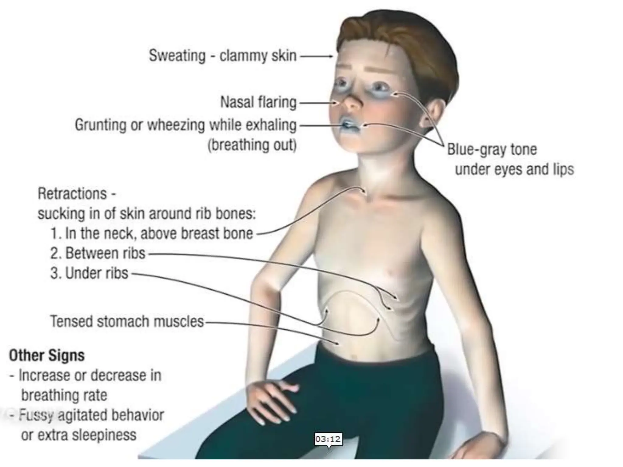 ASMA PPT DISEASE LUNGS HUMAN BODY MEDICINE | PPTX
