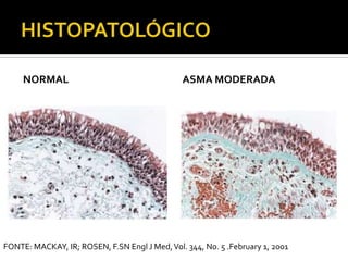 HISTOPATOLÓGICONormalAsma moderadaFONTE: MACKAY, IR; ROSEN, F.SN Engl J Med, Vol. 344, No. 5 .February 1, 2001