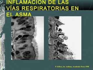 INFLAMACIÓN DE LAS
VÍAS RESPIRATORIAS EN
EL ASMA
Normal
P Jeffery, in: Asthma, Academic Press 1998
 