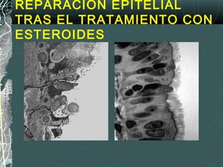 Antes
REPARACIÓN EPITELIAL
TRAS EL TRATAMIENTO CON
ESTEROIDES
 