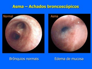 Asma – Achados broncoscópicos Brônquios normais Edema de mucosa Normal Asma 