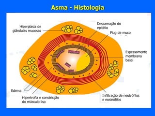 Infiltração de neutrófilos e eosinófilos Hipertrofia e constricção  do músculo liso Edema Hiperplasia de glândulas mucosas Descamação do epitélio Plug de muco Espessamento membrana basal Asma - Histologia 