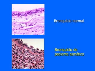 Bronquíolo normal Bronquíolo de paciente asmático 