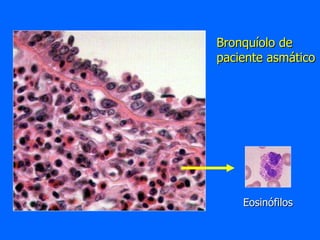 Bronquíolo de paciente asmático Eosinófilos 