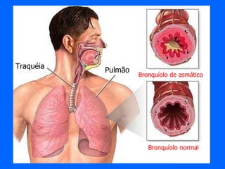 Bronquíolo de asmático Bronquíolo normal Pulmão Traquéia 