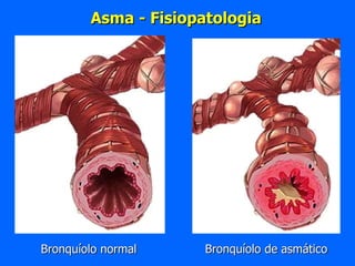 Bronquíolo normal Bronquíolo de asmático Asma - Fisiopatologia 