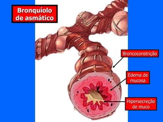 Hipersecreção de muco Edema de mucosa Broncoconstrição Bronquíolo normal Bronquíolo de asmático 