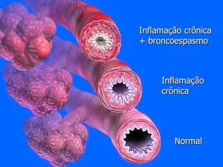 Normal Inflamação crônica Inflamação crônica + broncoespasmo 