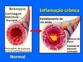 Normal Inflamação crônica 