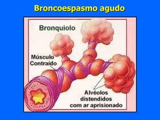 Broncoespasmo agudo 