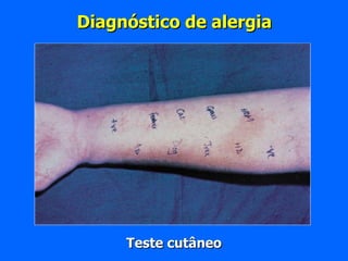 Diagnóstico de alergia Teste cutâneo 