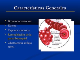Características Generales







Broncoconstricción
Edema
Tapones mucosos
Remodelación de la
pared bronquial
Obstrucción al flujo
aéreo

 