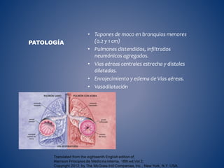 • Tapones de moco en bronquios menores
(0.2 y 1 cm)
• Pulmones distendidos, infiltrados
neumónicos agregados.
• Vías aéreas centrales estrecha y distales
dilatadas.
• Enrojecimiento y edema de Vías aéreas.
• Vasodilatación
PATOLOGÍA
 