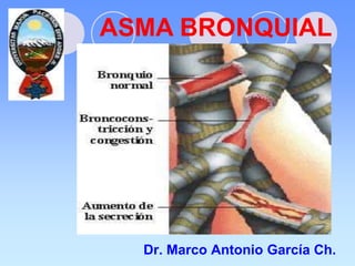 ASMA BRONQUIAL
Dr. Marco Antonio García Ch.
 