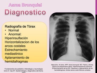 Radiografía de Tórax
• Normal
• Anormal:
Hiperinsuflación
Horizontalizacion de los
arcos costales
Estrechamiento
mediastinico
Aplanamiento de
hemidiafragmas
Masculino. 44 años. APP. Asma bronquial. MC: Fiebre y disnea.
Signos de atrapamiento aéreo. Hipertransparencia pulmonar.
Ensanchamiento de los EIC. Descenso y aplanamiento de los
hemidiafragmas. Ambos senos costo-frénicos cortados
Fundamentos de pediatría: infectologia y neumología
tomo II. Cap 87. Epidemiologia y diagnostico del Asma.
 