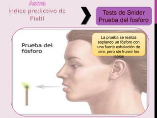 La prueba se realiza
soplando un fósforo con
una fuerte exhalación de
aire, pero sin fruncir los
labios
 