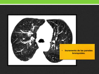• Incremento de las paredes
bronquiales.
 