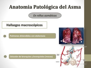 Hallazgos macroscópicos
En niños asmáticos
Pulmones distendidos con atelectasia
Oclusión de bronquios y bronquiolos (mocos)
Anatomia Patológica del Asma
 