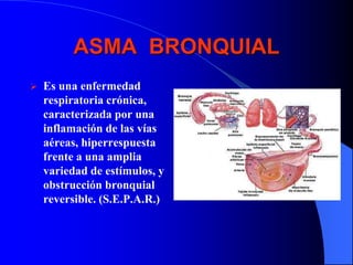 ASMA BRONQUIAL
 Es una enfermedad
respiratoria crónica,
caracterizada por una
inflamación de las vías
aéreas, hiperrespuesta
frente a una amplia
variedad de estímulos, y
obstrucción bronquial
reversible. (S.E.P.A.R.)
 
