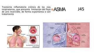 ASMA
Trastorno inflamatorio crónico de las vías
respiratorias, que presenta limitación del flujo
de aire reversible, de forma espontánea o con
tratamiento
J45
 