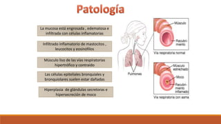 La mucosa está engrosada , edematosa e
infiltrada con células inflamatorias
Hiperplasia de glándulas secretoras e
hipersecreción de moco
Las células epiteliales bronquiales y
bronquiolares suelen estar dañadas
Infiltrado inflamatorio de mastocitos ,
leucocitos y eosinófilos
Músculo liso de las vías respiratorias
hipertrófico y contraído
 