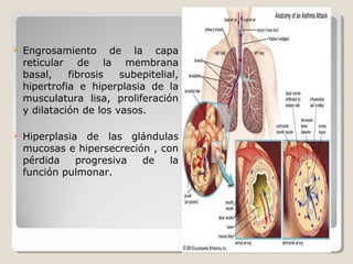  Engrosamiento de la capa
reticular de la membrana
basal, fibrosis subepitelial,
hipertrofia e hiperplasia de la
musculatura lisa, proliferación
y dilatación de los vasos.
 Hiperplasia de las glándulas
mucosas e hipersecreción , con
pérdida progresiva de la
función pulmonar.
 