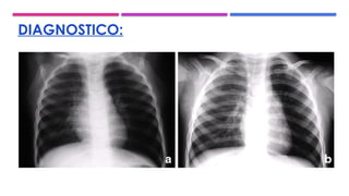 DIAGNOSTICO:
 