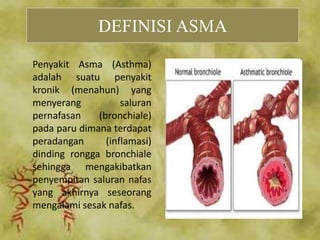 DEFINISI ASMA
Penyakit Asma (Asthma)
adalah suatu penyakit
kronik (menahun) yang
menyerang saluran
pernafasan (bronchiale)
pada paru dimana terdapat
peradangan (inflamasi)
dinding rongga bronchiale
sehingga mengakibatkan
penyempitan saluran nafas
yang akhirnya seseorang
mengalami sesak nafas.
 
