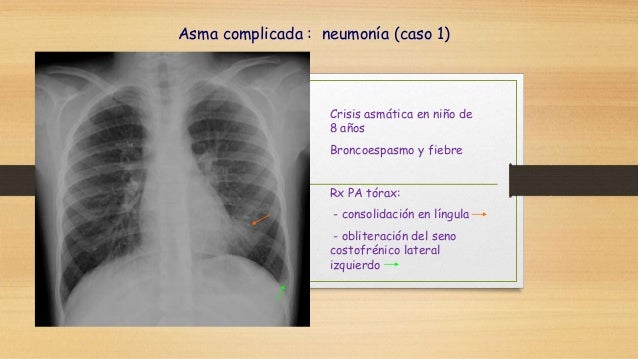 Asma y atelectasia Asma y atelectasia