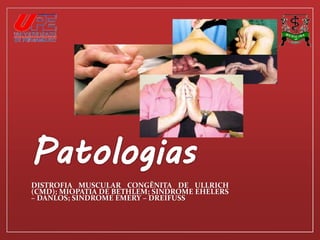 DISTROFIA MUSCULAR CONGÊNITA DE ULLRICH 
(CMD); MIOPATIA DE BETHLEM; SINDROME EHELERS 
– DANLOS; SINDROME EMERY – DREIFUSS 
 