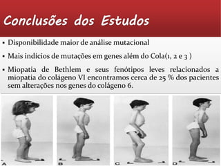  Disponibilidade maior de análise mutacional 
 Mais indícios de mutações em genes além do Cola(1, 2 e 3 ) 
 Miopatia de Bethlem e seus fenótipos leves relacionados a 
miopatia do colágeno VI encontramos cerca de 25 % dos pacientes 
sem alterações nos genes do colágeno 6. 
 