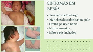 SINTOMAS EM
BEBÊS:
• Pescoço alado e largo
• Manchas descoloridas na pele
• Orelha posição baixa
• Muitos mamilos
• Mãos e pés inchados
 