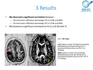3 Results
• We observed a significant correlationbetween :
– GA and tumor infiltration percentage (TI) (r=-0.98 p=0.006).
– GV and tumor infiltration percentage (TI) (r=-0.98 p=0.006).
• MD showed no significant correlation(r=0.11 p=0.76) with TI.
Fig. 5. GA maps.
Left: (patient number: 03) Right frontoparietal
glioblastoma showing low GAsignal in a
peripheral ROI (red arrow) and 0% TI on
histology.
Right: (patient number: 07) Left parietal
glioblastoma showing high GAsignal in a
peripheral ROI (yellow arrow) and an 10% TI
on histology.
 