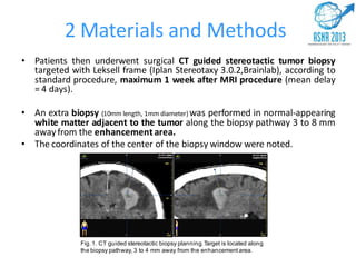 2 Materials and Methods
• Patients then underwent surgical CT guided stereotactic tumor biopsy
targeted with Leksell frame (Iplan Stereotaxy 3.0.2,Brainlab), according to
standard procedure, maximum 1 week after MRI procedure (mean delay
= 4 days).
• An extra biopsy (10mm length, 1mm diameter) was performed in normal-appearing
white matter adjacent to the tumor along the biopsy pathway 3 to 8 mm
awayfrom the enhancementarea.
• The coordinates of the center of the biopsy window were noted.
Fig. 1. CT guided stereotactic biopsy planning. Target is located along
the biopsy pathway, 3 to 4 mm away from the enhancement area.
 
