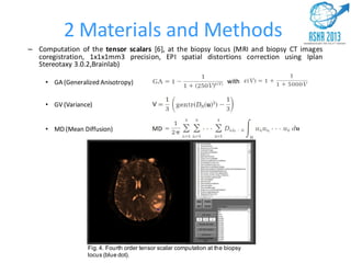2 Materials and Methods
– Computation of the tensor scalars [6], at the biopsy locus (MRI and biopsy CT images
coregistration, 1x1x1mm3 precision, EPI spatial distortions correction using Iplan
Stereotaxy 3.0.2,Brainlab)
• GA (Generalized Anisotropy)
• GV (Variance)
• MD (Mean Diffusion)
with
Fig. 4. Fourth order tensor scalar computation at the biopsy
locus (blue dot).
 