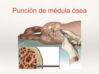 Punción de médula ósea
 